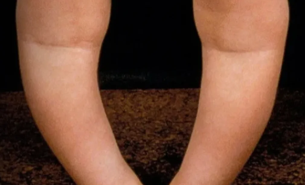 Rickets