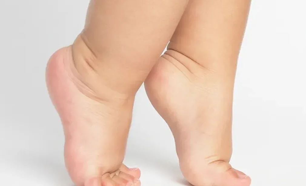Toe Walking