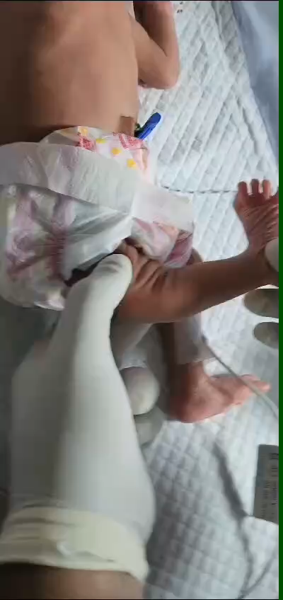 Congenital knee dislocation after treatment