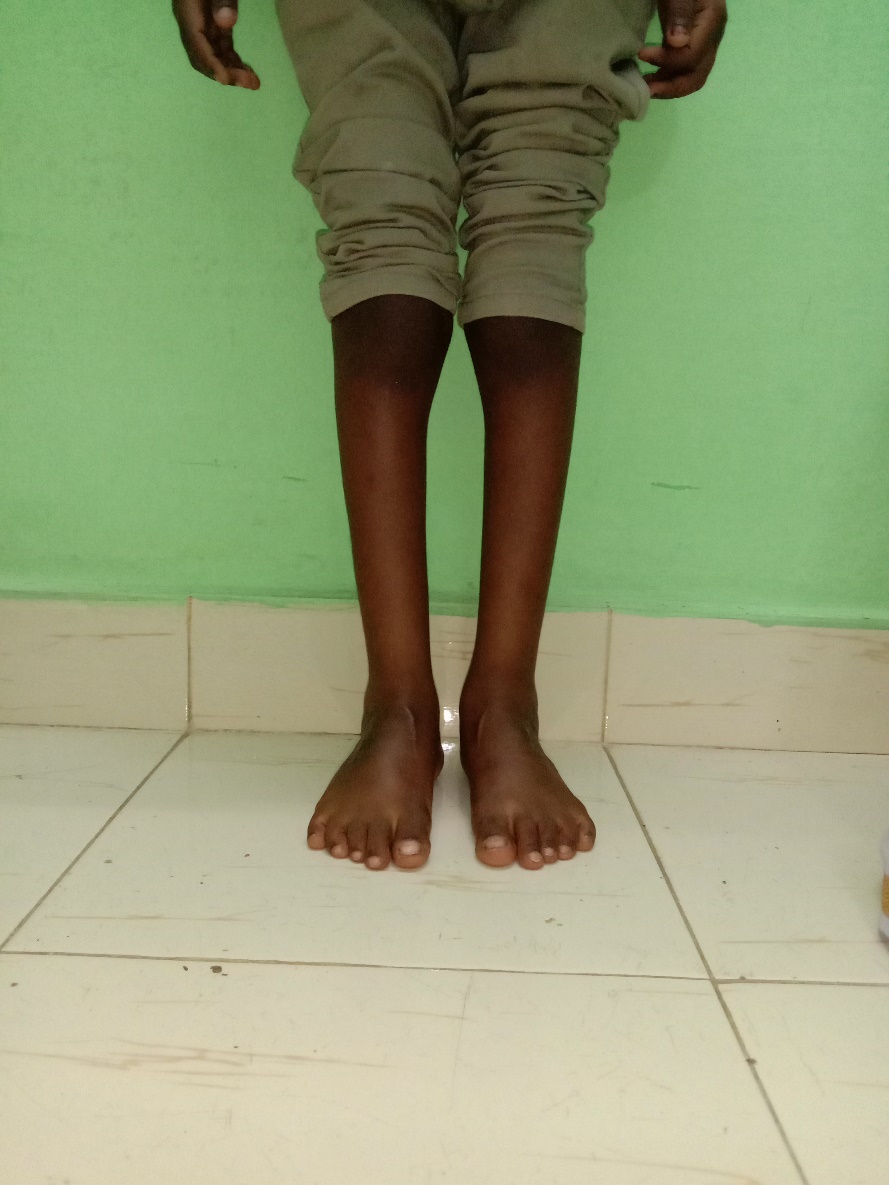 Recurrent clubfoot after treatment