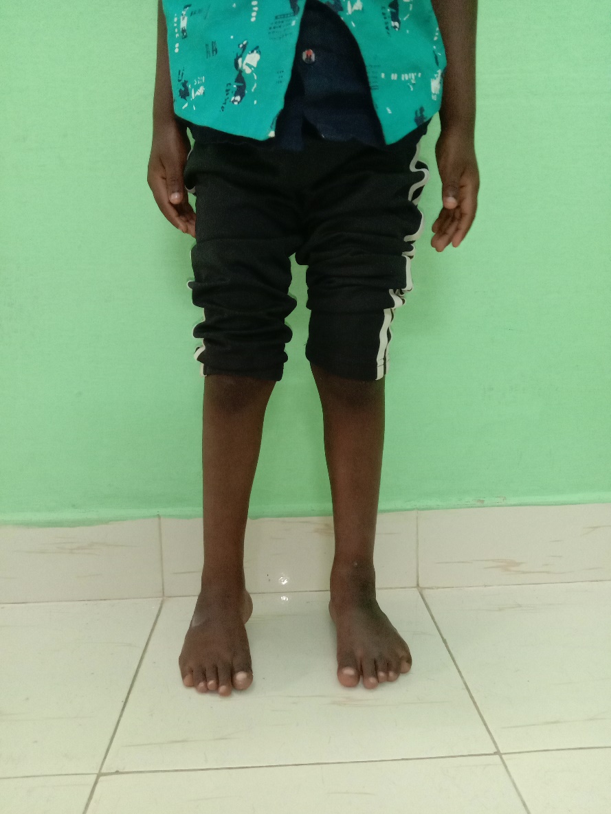 Recurrent clubfoot before treatment