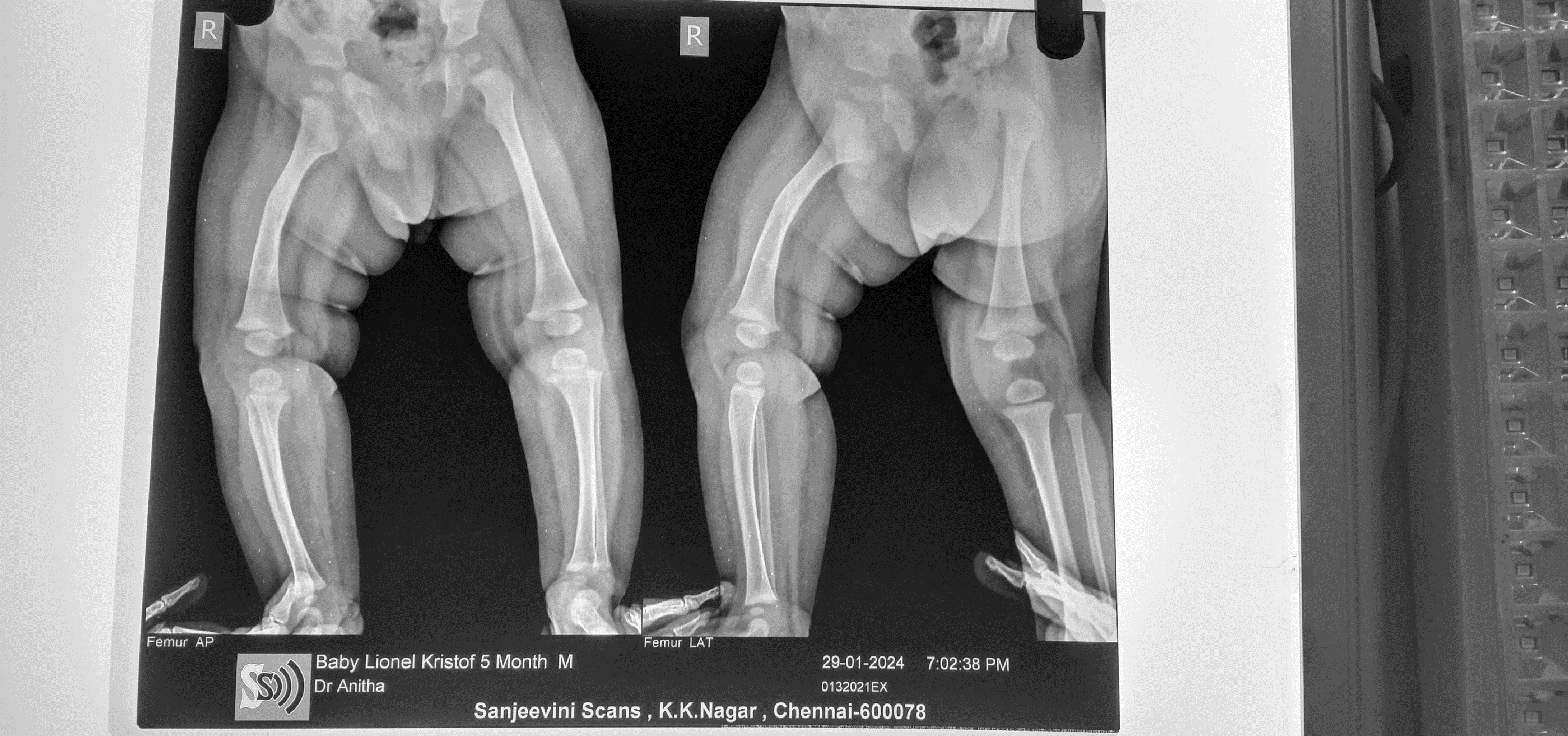 Birth fracture femur after treatment