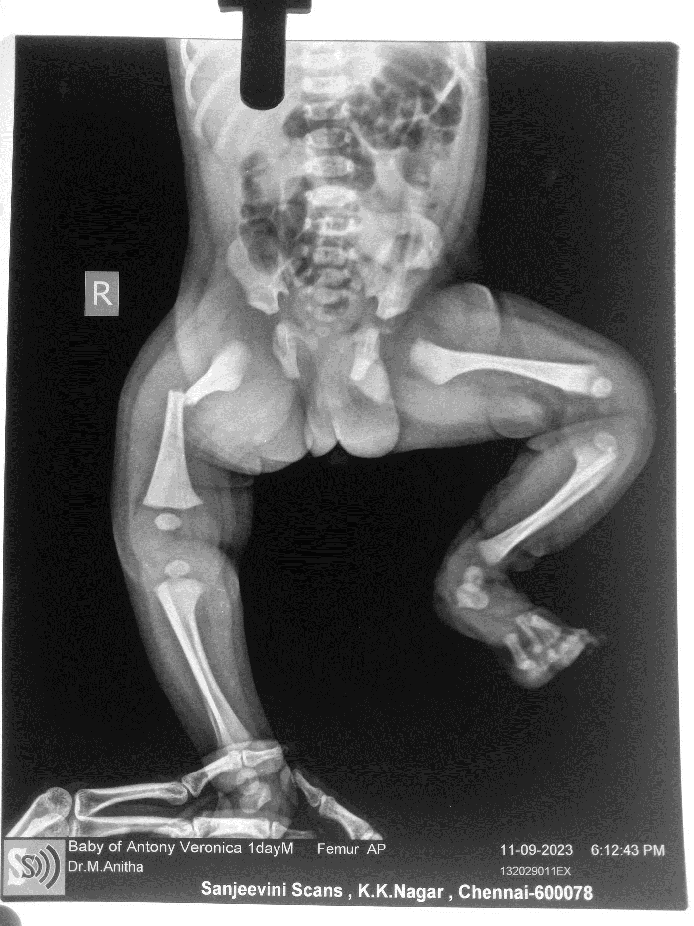 Birth fracture femur before treatment