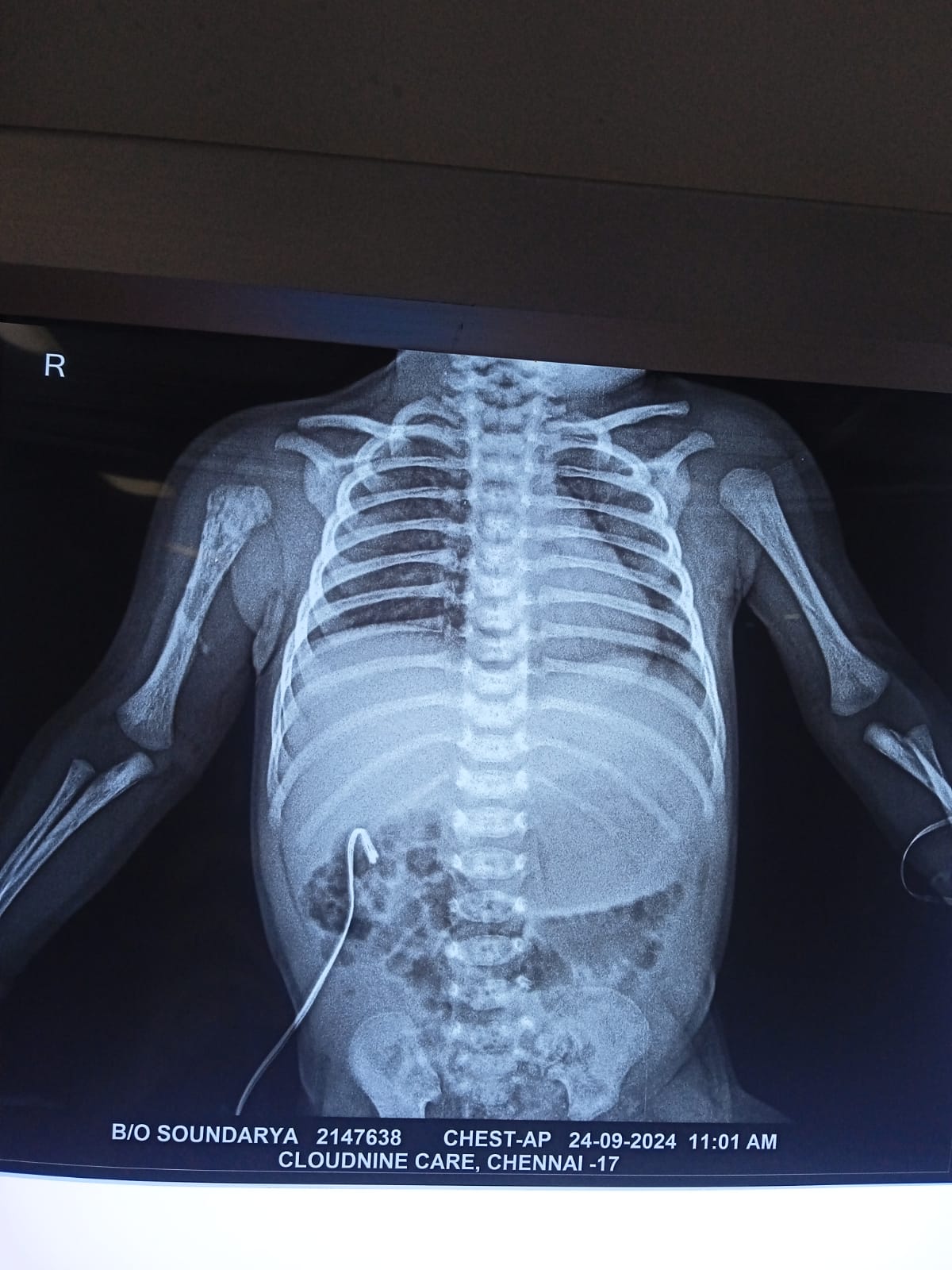 Osteomyelitis humerus before treatment