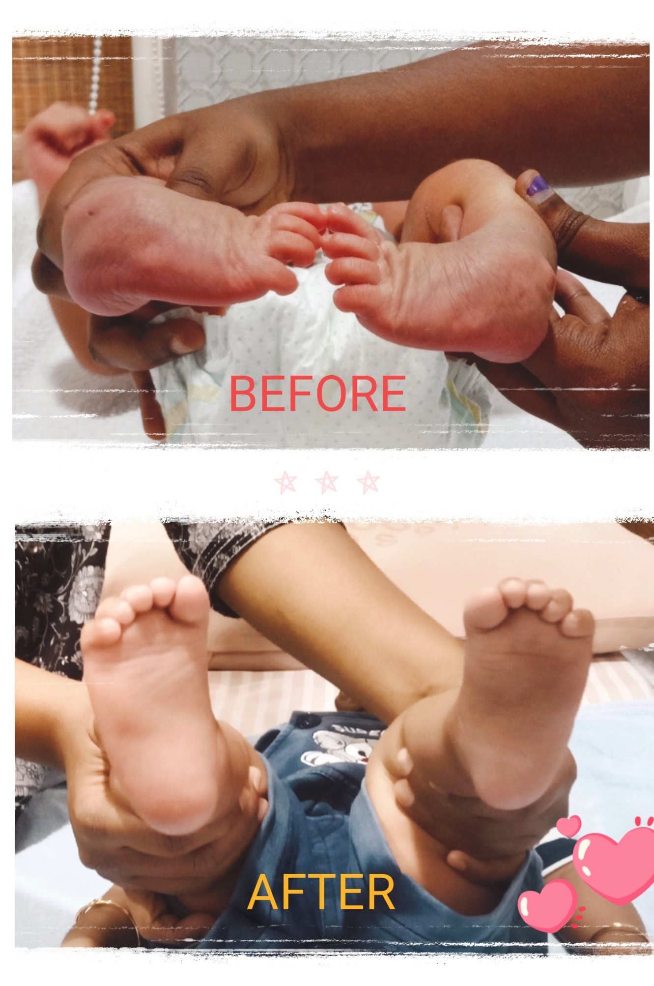 Bilateral clubfoot before treatment