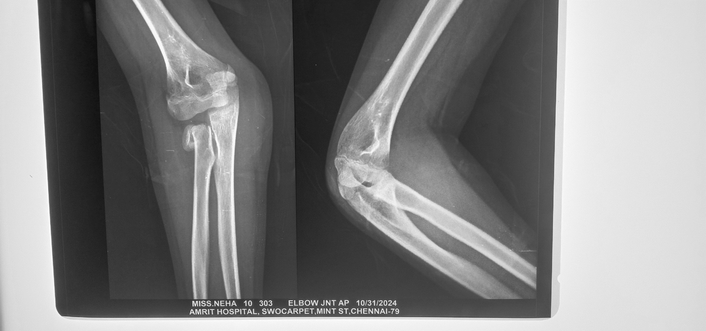Radial neck fracture before treatment
