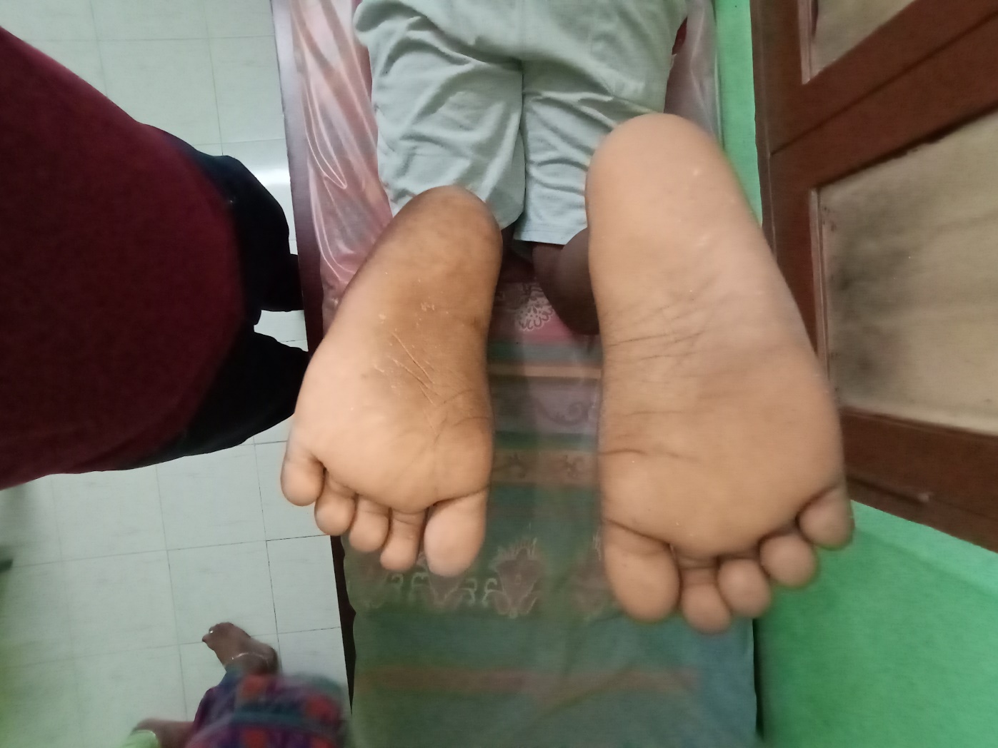 Resistant clubfoot after treatment