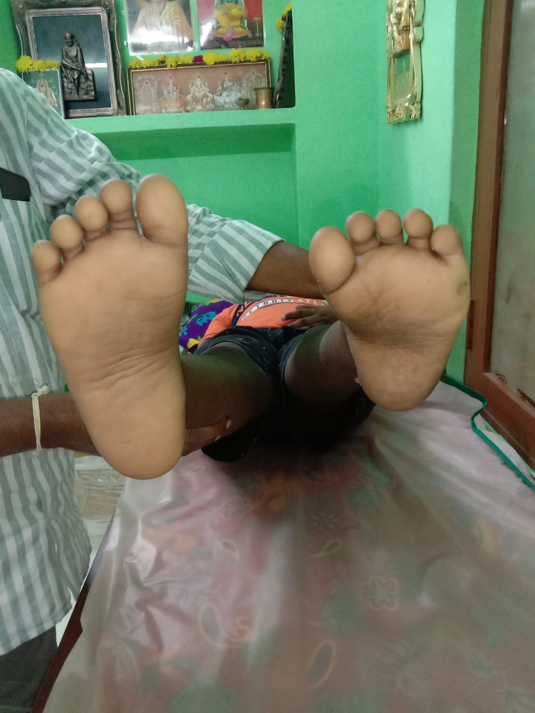 Resistant clubfoot before treatment