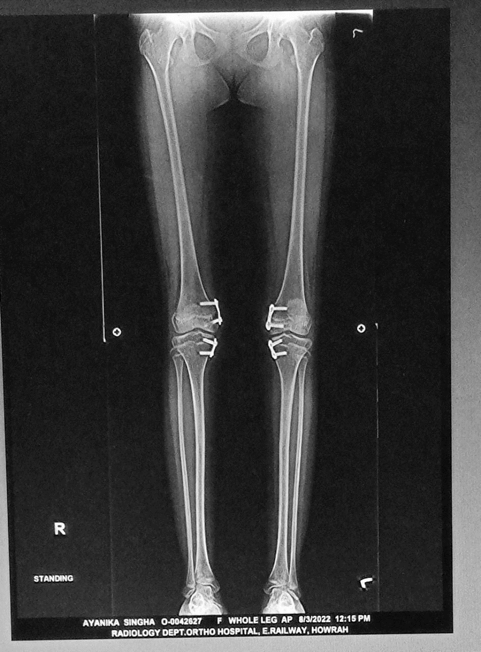 Bilateral genu valgum after treatment