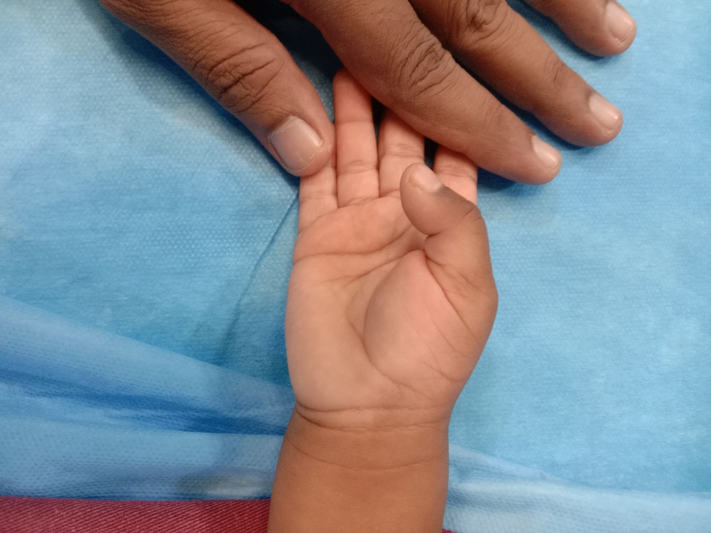 Congenital trigger thumb before treatment