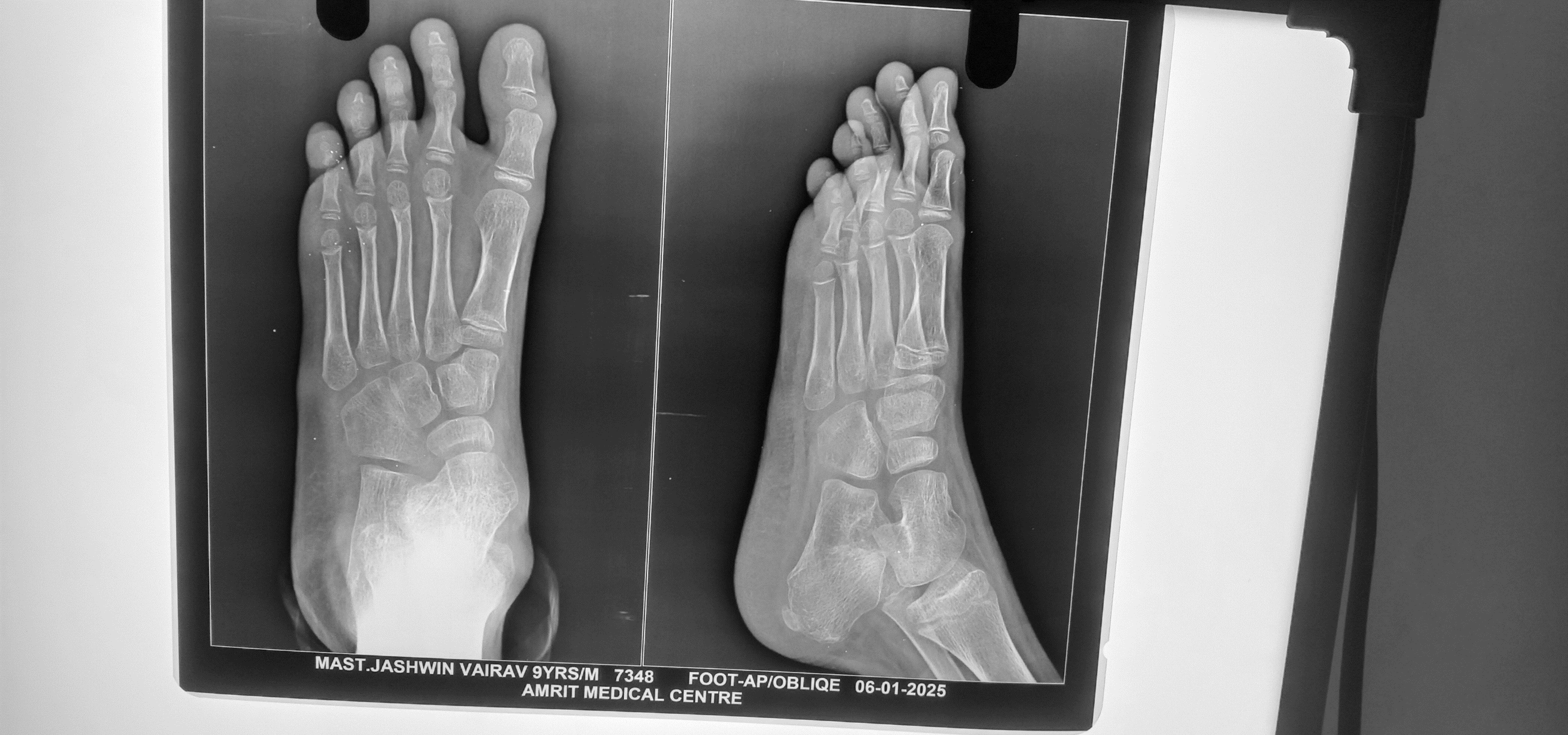 Metatarsal fracture after treatment