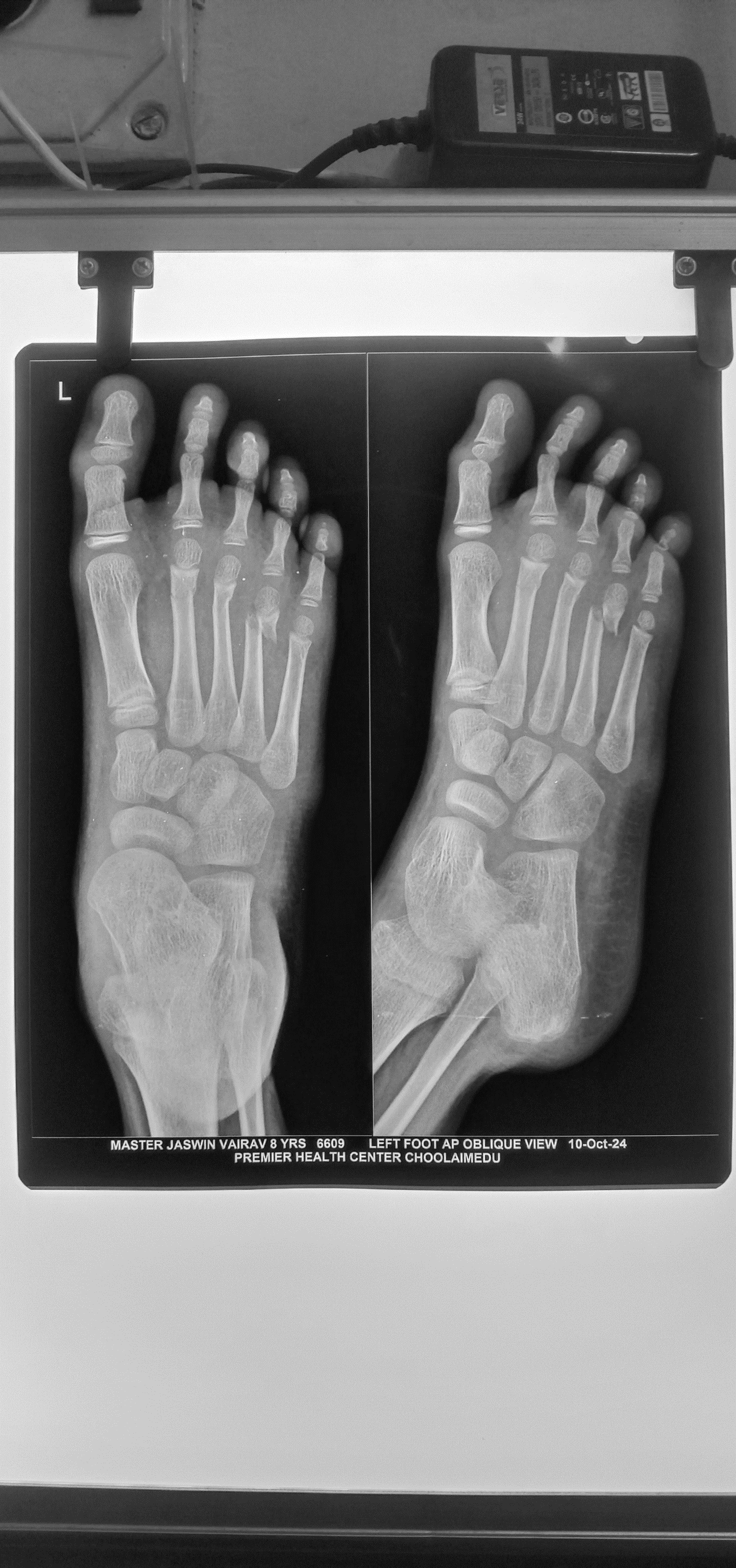 Metatarsal fracture before treatment